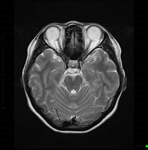 the villages mri scan brain